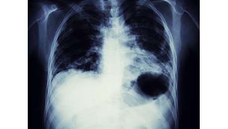 Nuove prospettive nella terapia del tumore al polmone non operabile
