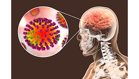 Primo caso di influenza australiana H3N2 isolato in Italia: il virus colpisce anche il cervello. Il monito di Bassetti