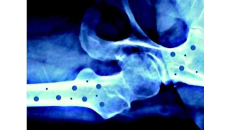 Il 20 ottobre 'Giornata mondiale dell’osteoporosi'